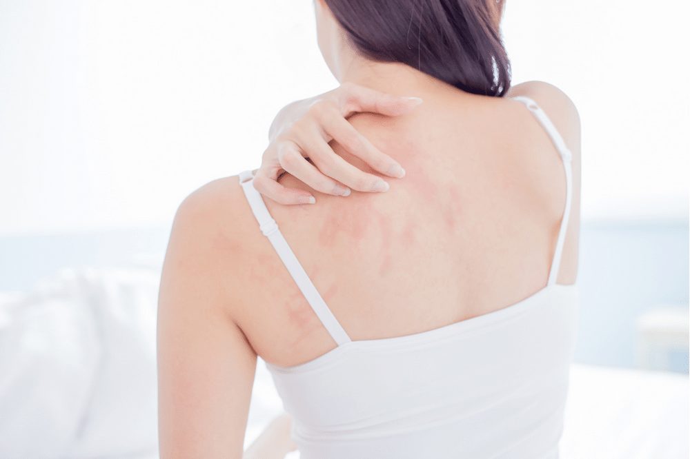CBD and eczema – does it work?
